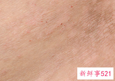 脸上有螨虫怎么办才能去除