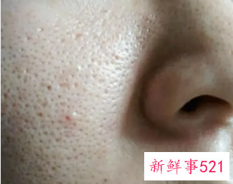 皮肤毛孔还粗大的解决方法