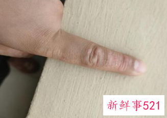 手指色素沉淀怎么办