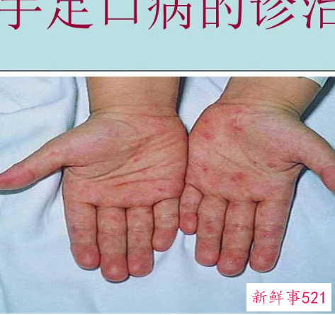 手足口病怎么治疗