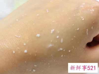 痘痘族如何正确保养肌肤