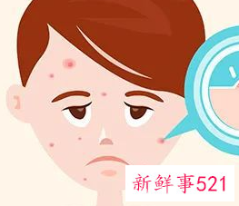 脸上长痘油脂分泌太多小妙招