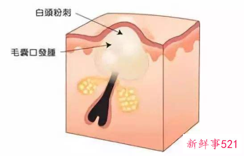 去除白头粉刺的小窍门有哪些呢