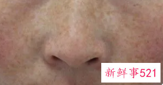 脸上有杂面星怎样祛除