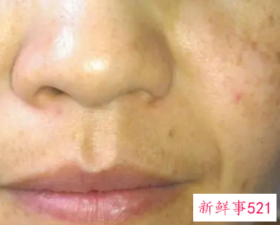 脸上有杂面星怎样祛除