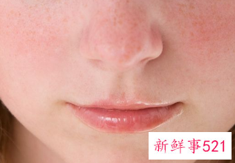 脸反复过敏发红痒怎么去除