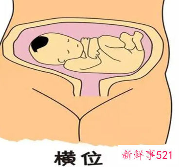 胎位不正怎么调整