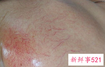 红血丝会随着年龄慢慢淡化吗