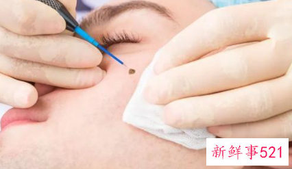 身上哪些痣有可能癌变