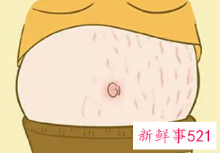 涂芦荟胶可以预防妊娠纹加重吗