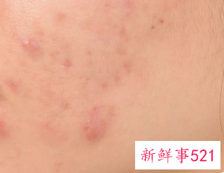 痘坑日常修复方法