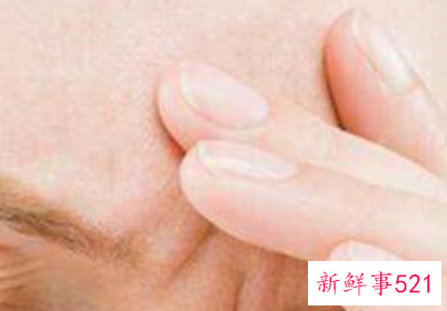 川字纹打玻尿酸能维持多久