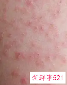 怎样判断过敏还是湿疹