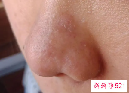 鼻子两侧发红干燥脱皮图片