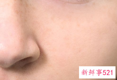 脸上有螨虫怎么办才能去除