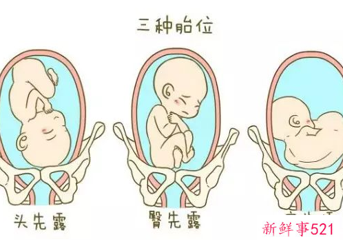 胎位不正怎么调整