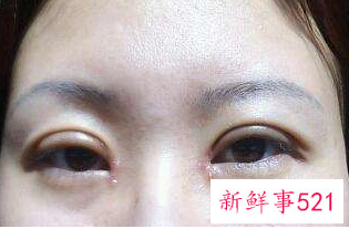 开眼角后可以抽烟吗