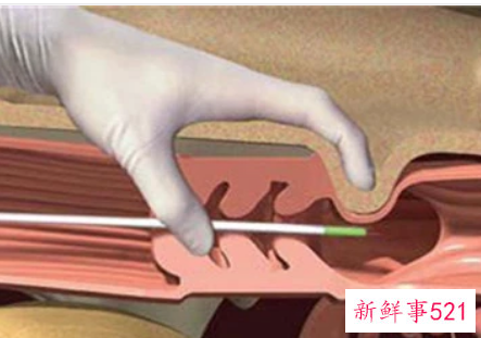 人工授精是什么