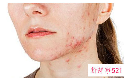 青春期脸上长痘痘调理