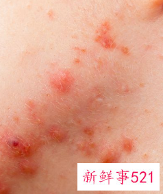 怎样判断过敏还是湿疹