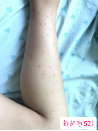 腿上有红点是怎么回事