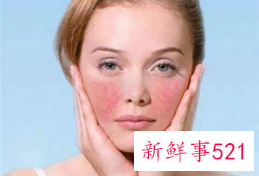 皮肤过敏要注意哪些事情