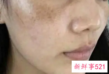 有关激光祛斑的7大偏见