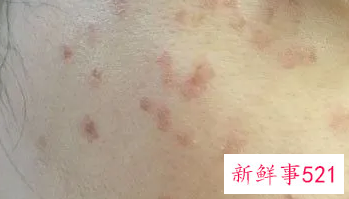 有关激光祛斑的7大偏见