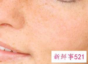 怎样把皮肤里的黑色素代谢出来