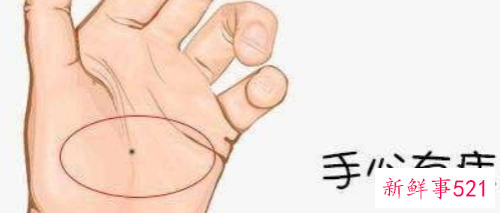 身上哪些痣有可能癌变