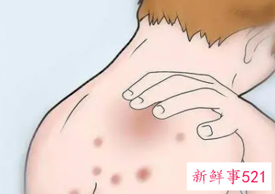 后背长痘痘是什么原因导致