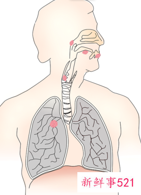 扁桃体腺样体切除利弊有哪些
