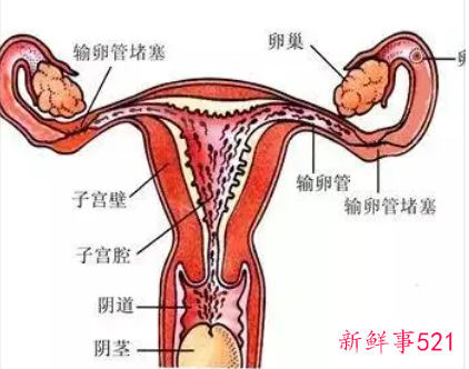 女人盆腔积液跟男人系吗