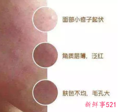 敏感肌会不会变成激素脸