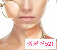 脸上起皮干燥紧绷刺痛怎么办