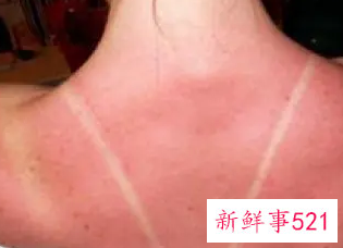 皮肤晒伤了应该怎么处理比较好