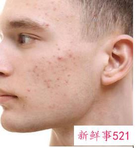 毛孔粗大堵塞黑头怎么治疗