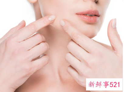 适合学生的祛痘办法