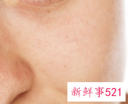 脸上的色斑是什么