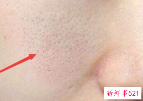 如何解决令人烦恼不已的毛孔粗大问题