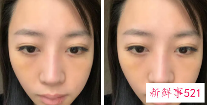 不手术去眼袋的方法如下