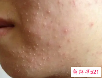 青春痘应该怎么去除