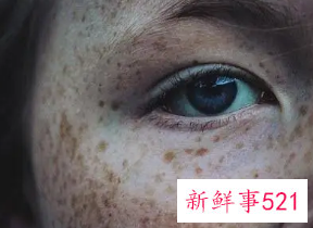 激光去色素沉着价格