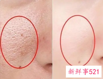 脸上有螨虫去除