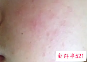 脸化妆品过敏怎么办