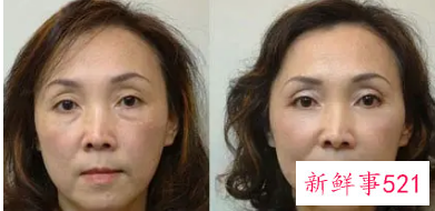 不手术去眼袋的方法如下