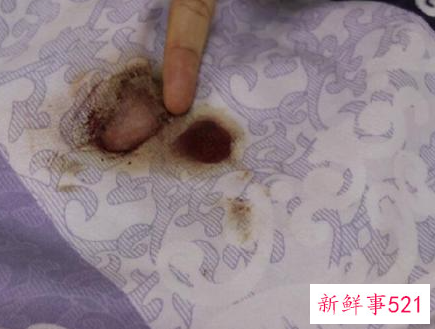 床单上的血渍怎样清除