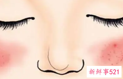 有红血丝就是敏感肌吗