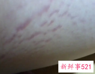 白色的是肥胖纹还是生长纹