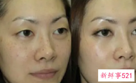 为什么脸上的黑色素沉积排不出来怎么办